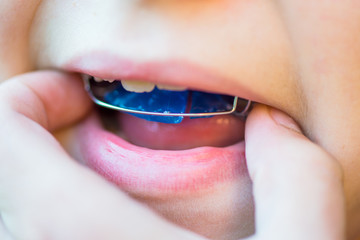 Boy Removes his Dental Blue Removable Brace or Retainer for Teet