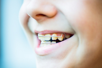 Dental  Removable Brace or Retainer for Teeth in the Boys Mouth