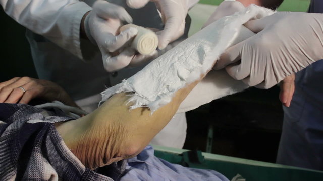 A patient with a broken arm. Bandaging broken bones in hospital.