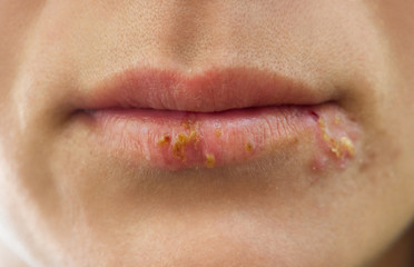 lips affected by herpes - obrazy, fototapety, plakaty