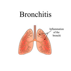 Bronchitis. The anatomical structure of the human lung. Vector