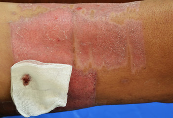 Skin graft wound.
