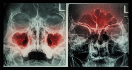 Film X-ray paranasal sinus : show sinusitis at maxillary sinus ( left image ) , frontal sinus ( right image )