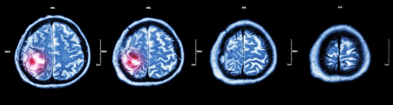 Brain tumor  ( Film CT-scan of brain : show part of brain with tumor )