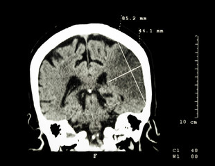 Cerebral infarction at left hemisphere ( Ischemic stroke ) ( CT-scan of brain ) : Medicine and...