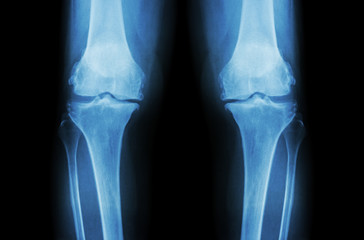 Osteoarthritis Knee ( OA Knee ). Film x-ray both knee ( front view ) show narrow joint space (...
