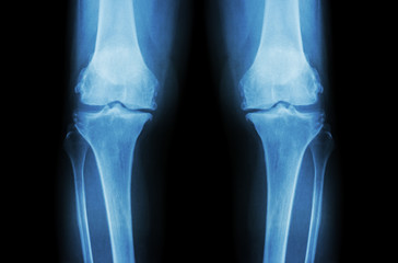 Osteoarthritis Knee ( OA Knee ). Film x-ray both knee ( front view ) show narrow joint space (...