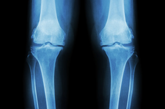 Osteoarthritis Knee ( OA Knee ). Film x-ray both knee ( front view ) show narrow joint space ( joint cartilage loss ) , osteophyte , subchondral sclerosis