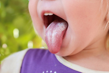 White coating on tongue baby. Oral thrush. 