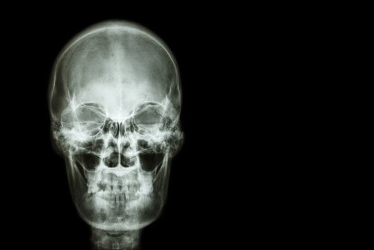 film x-ray skull of human and blank area at right side ( Medical , Science and Healthcare concept and background )