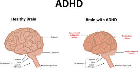 ADHD