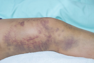 Closeup on a Bruise on wounded woman leg skin