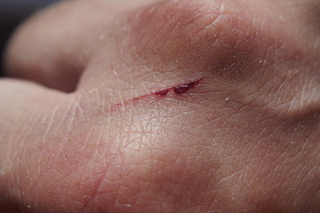 Порез на кисти руки