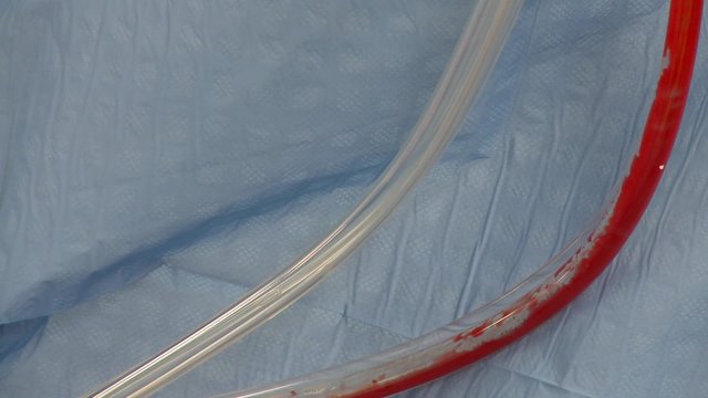 Spinal surgery blood