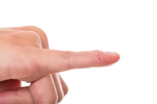 Nahaufnahme kleiner Finger mit Panaritium, Konzept Verletzung Na