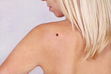 Young woman looking at birthmark on her back, skin. Checking benign moles - obrazy, fototapety, plakaty