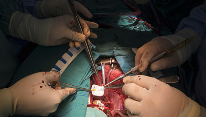 total correction tetalogy of follot