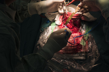 neurosurgeon remove brain tumor