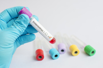 Fototapeta premium Enterovirus blood sample