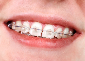 Teeth with orthodontic brackets.