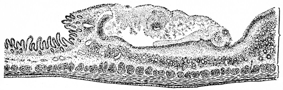 Section through a typhoid ulcer, vintage engraving.