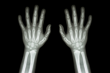 Film X-ray normal both hands of child