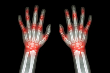 Rheumatoid arthritis , Gout arthritis  ( Film x-ray both hands of child with multiple joint arthritis ) ( Medical , Science and Health care concept ) - obrazy, fototapety, plakaty