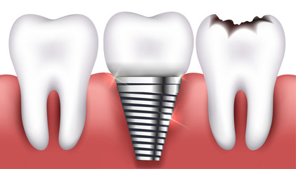 Healthy tooth, toorh with caries and dental implant