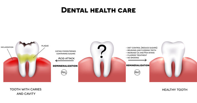 Dental health care, healthy tooth and tooth with caries