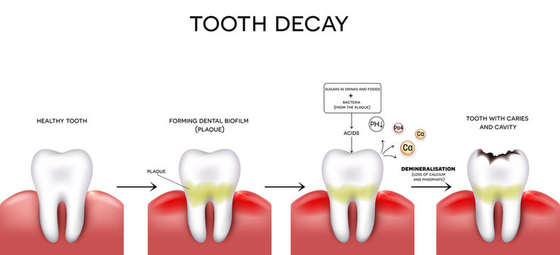 Tooth Decay Formation