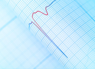 Danger sign on the patient's ECG, close-up