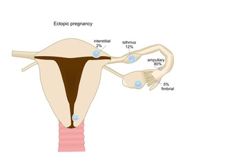 Principali aree in cui si può sviluppare una gravidanza ectopica
