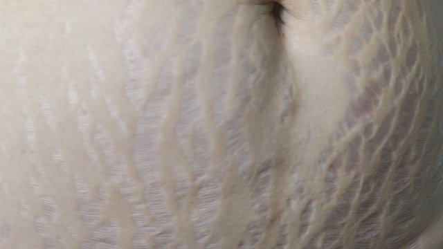 Closeup stretch mark on post pregnant woman belly 