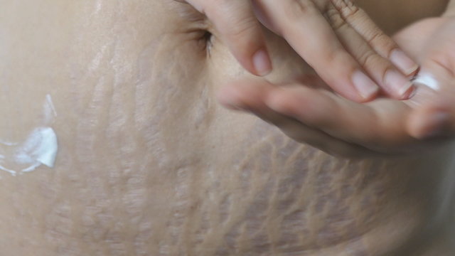 Post pregnant woman apply lotion on her belly with stretch mark 
