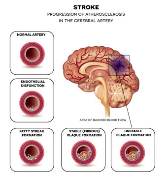 Stroke in the brain artery