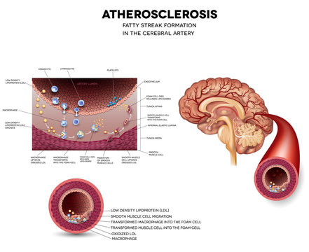 Atherosclerosis. Fatty streak formation in the brain