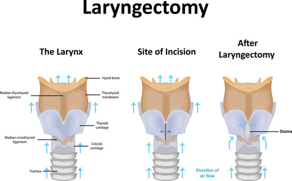 Laryngectomy Illustration