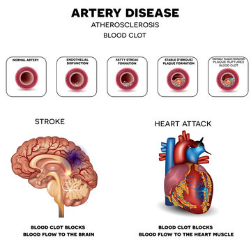 Artery disease, Atherosclerosis, Stroke and Heart attack