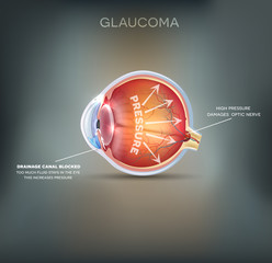 Glaucoma