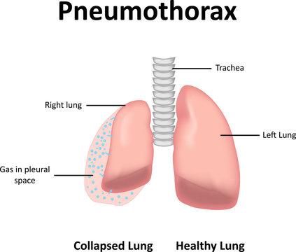 Pneumothorax Illustration