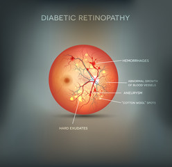 Diabetic retinopathy background