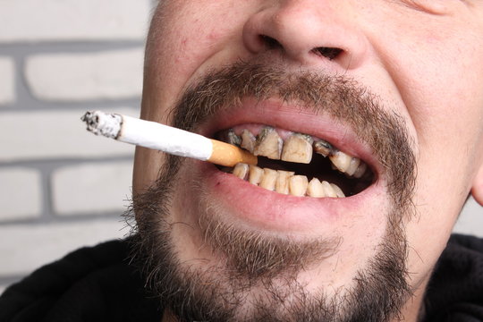 Bad teeth smoker sick