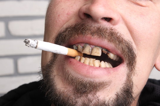 Bad teeth smoker sick