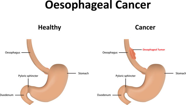 Oesophageal Cancer Illustration 
