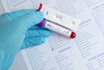 Hepatitis C virus (HCV) testing positive