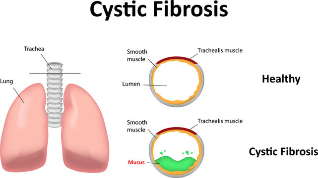 Cystic Fibrosis in the Lungs