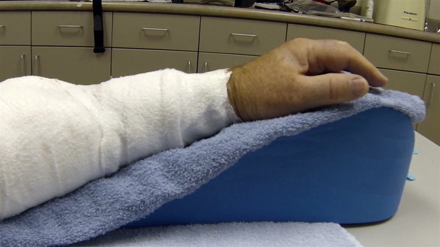 Patient's arm in bandage after major surgery HD 005