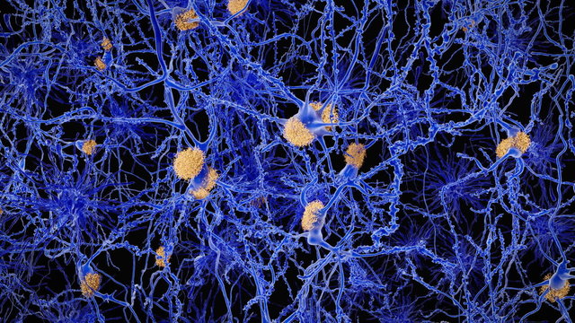 Alzheimer Krankheit, Neuronen mit Amyloidplaques