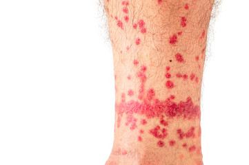 Flea Bites on Human Leg