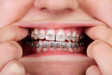 Obraz premium Teeth with orthodontic brackets.